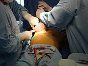 Einführung der Transplantate (Foto: Petra Knott)